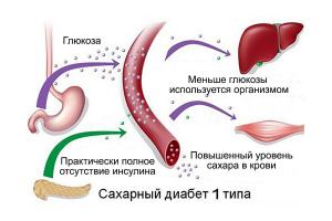 Сахарный диабет