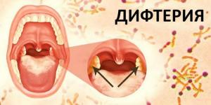 Дифтерия