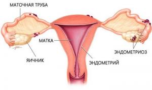 Эндометриоз